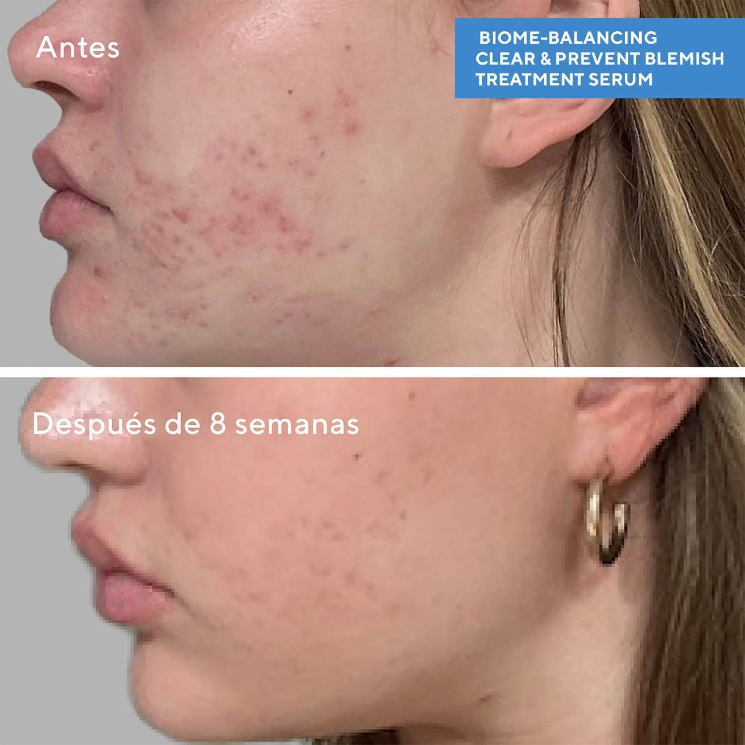 BIOME-BALANCING CLEAR & PREVENT BLEMISH TREATMENT SERUM (SUERO ACLARADOR - PREVIENE IMPERFECCIONES Y EQUILIBRA EL MICROBIOMA)